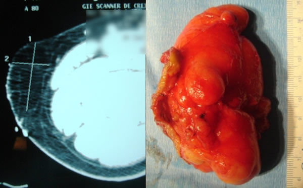 Lipome sous cutané