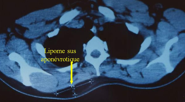 Lipomes sous cutané du dos