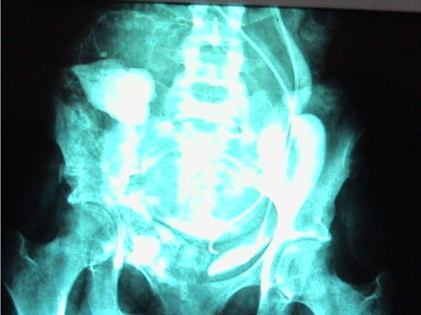 tumor of pelvis chemotherapy