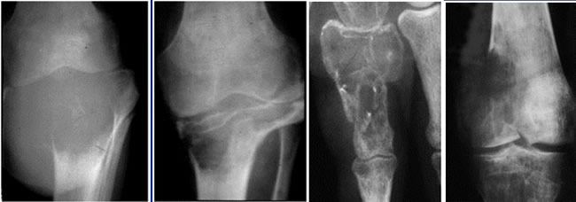 Tumeurs à cellules géantes