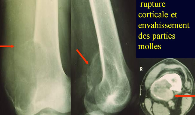 Tumeurs à cellules géantes