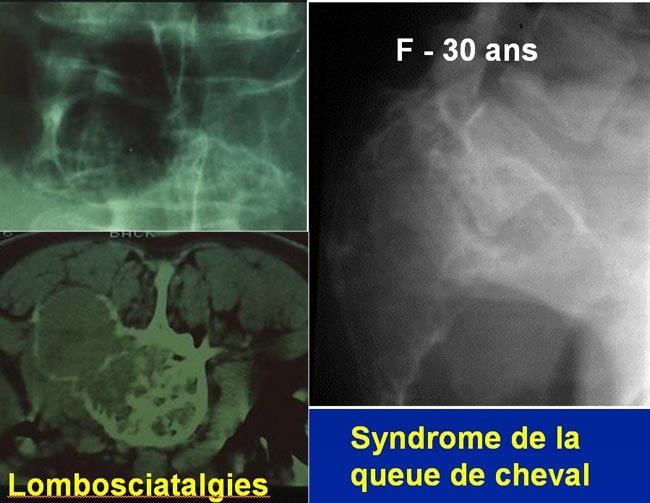 Tumeurs à cellules géantes