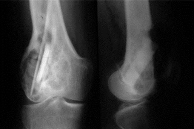 Tumeurs à cellules géantes