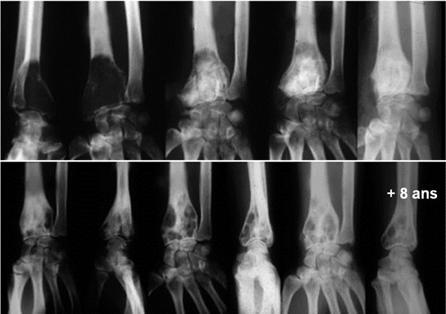 Tumeurs à cellules géantes