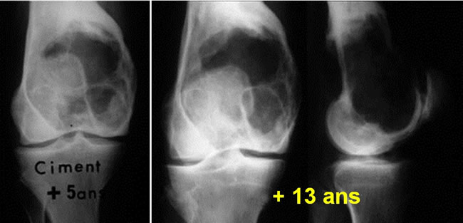 Tumeurs à cellules géantes