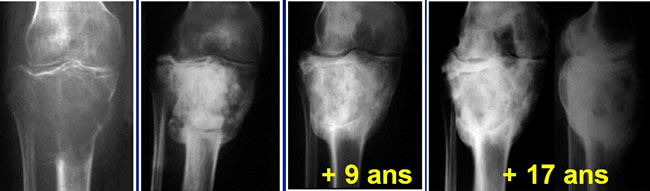 Tumeurs à cellules géantes