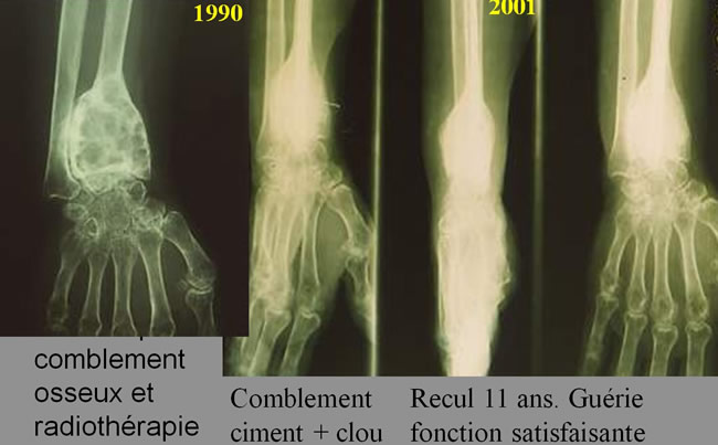 Tumeurs à cellules géantes