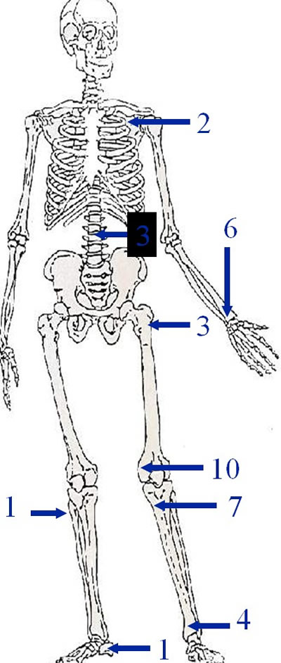 Tumeurs à cellules géantes