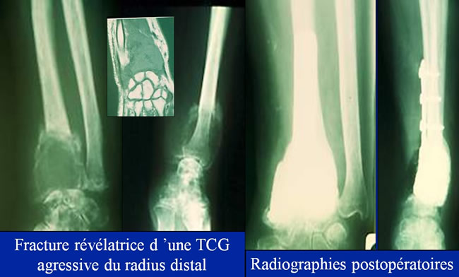 Tumeurs à cellules géantes