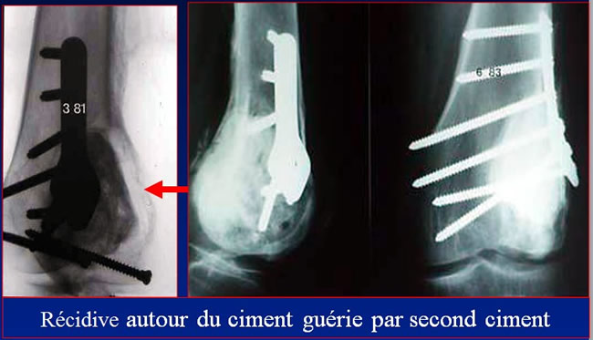 Tumeurs à cellules géantes