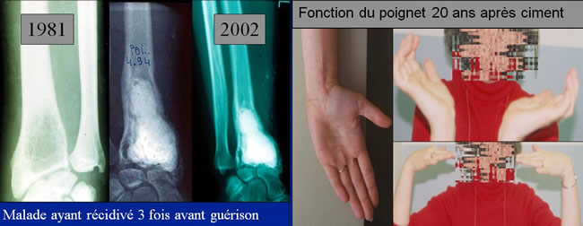 Tumeurs à cellules géantes