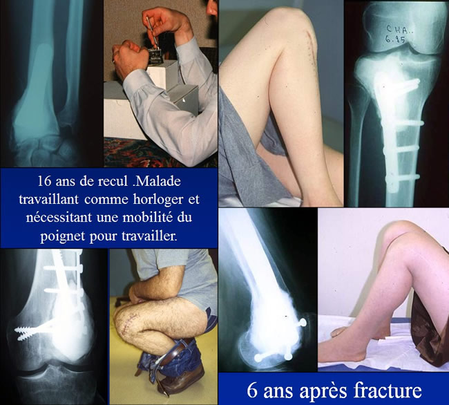 Tumeurs à cellules géantes