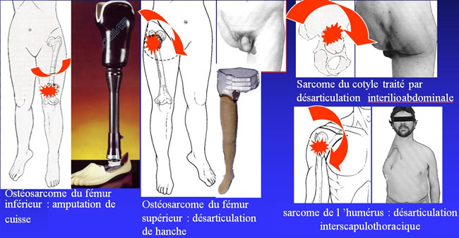 traitement chirurgical des sarcomes osseux