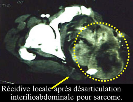 traitement chirurgical des sarcomes osseux