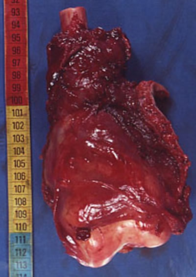 traitement chirurgical des sarcomes osseux