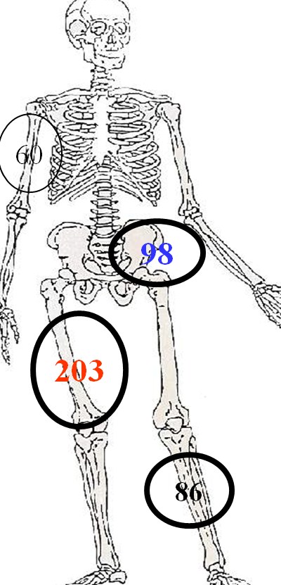 traitement chirurgical des sarcomes osseux