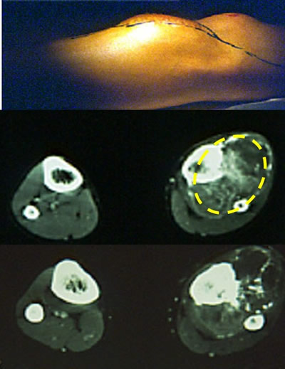 traitement chirurgical des sarcomes osseux