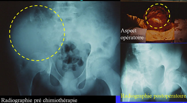 traitement chirurgical des sarcomes osseux