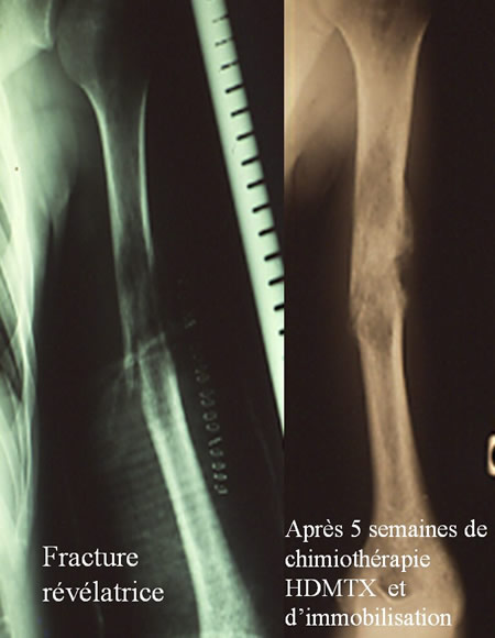 traitement chirurgical des sarcomes osseux