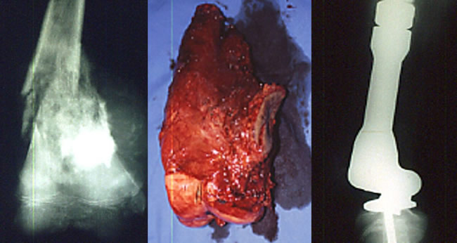 traitement chirurgical des sarcomes osseux