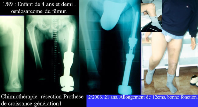 traitement chirurgical des sarcomes osseux