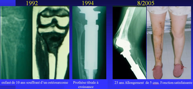 traitement chirurgical des sarcomes osseux