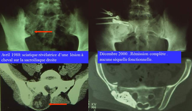 traitement chirurgical des sarcomes osseux