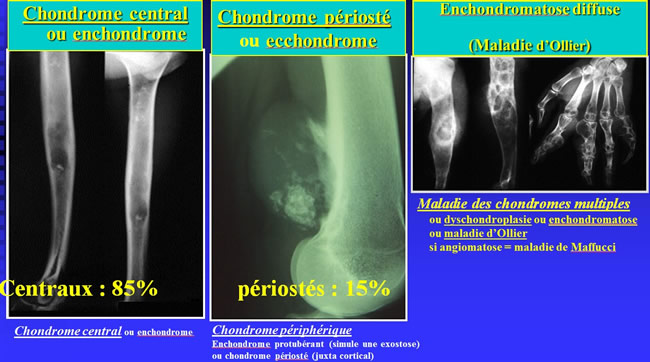 Chondromes