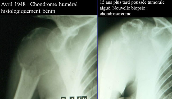 Chondromes