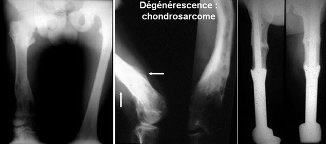 Chondromes