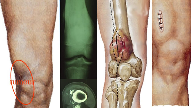 osteosarcoma