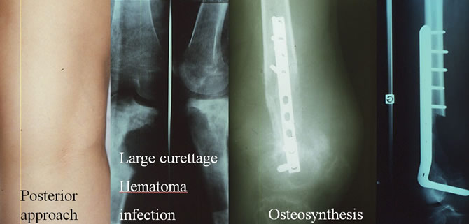 osteosarcoma