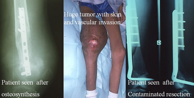 osteosarcoma