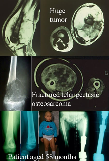 osteosarcoma