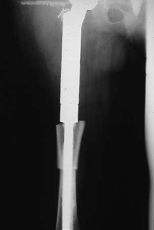 Radiographie de la prothèse