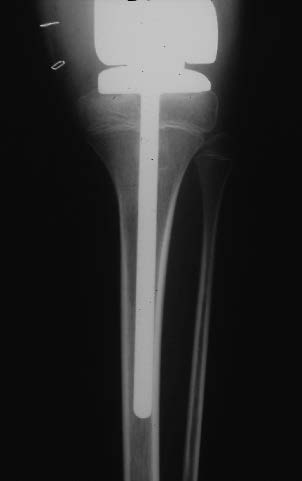 élément tibial pour prothèse de croissance fémorale inférieure