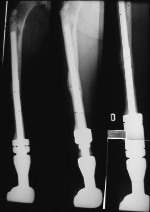 Radiographie d'une prothèse de croissance fémorale