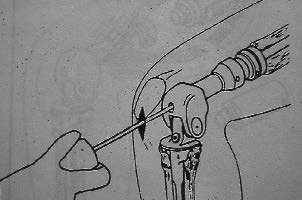 allongement par arthroscopie d'une prothèse