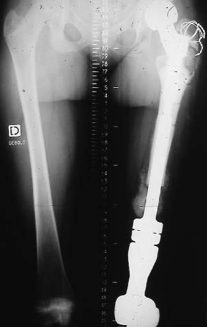 reconstruction par prothse du fmur entier