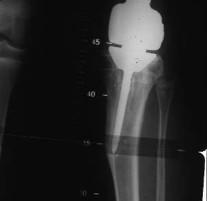 Strilisation partielle du cartilage