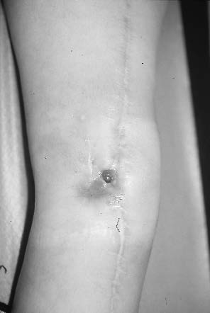 Infection d'une prothèse massive pour ostéosarcome