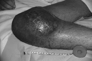 volumineux ostéosarcone du tibia