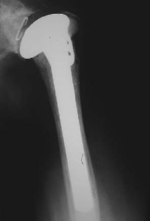 diagnostic d'ostéosarcome radique