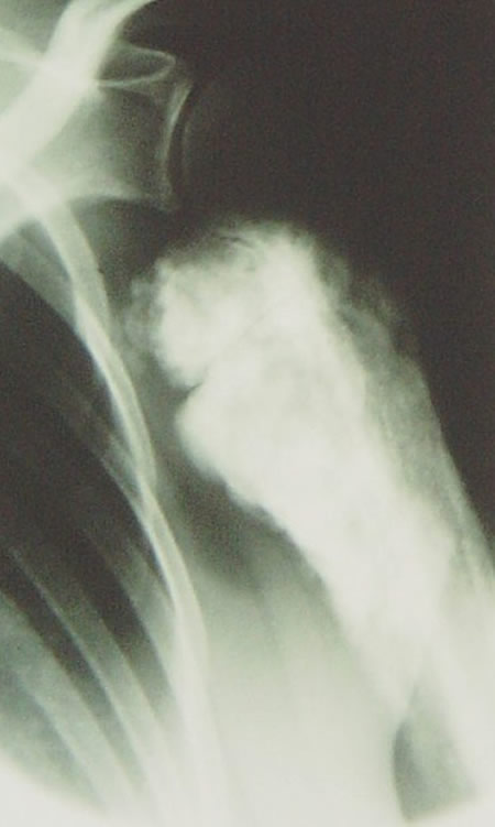 osteosarcome juxtacortical