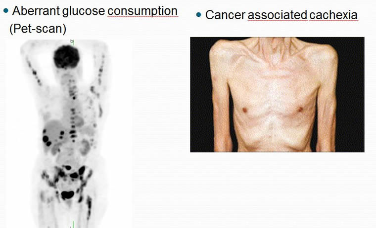 metabolic alteration of cancer