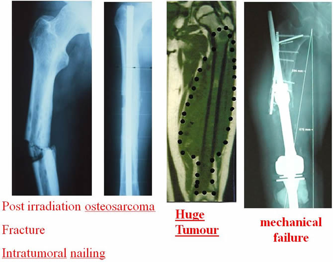 femur resection