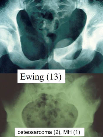 Ewing osteosarcoma