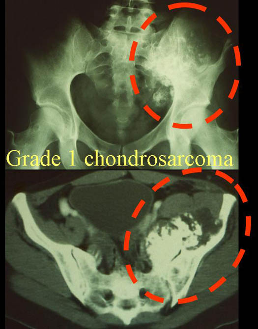 Grade 1 Chondrosarcoma