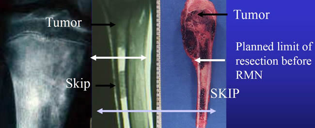 skip lesion from tibia osteosarcoma