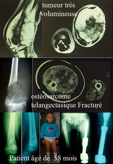 Différents Ostéosarcomes